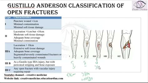 Open Fractures (Gustilo